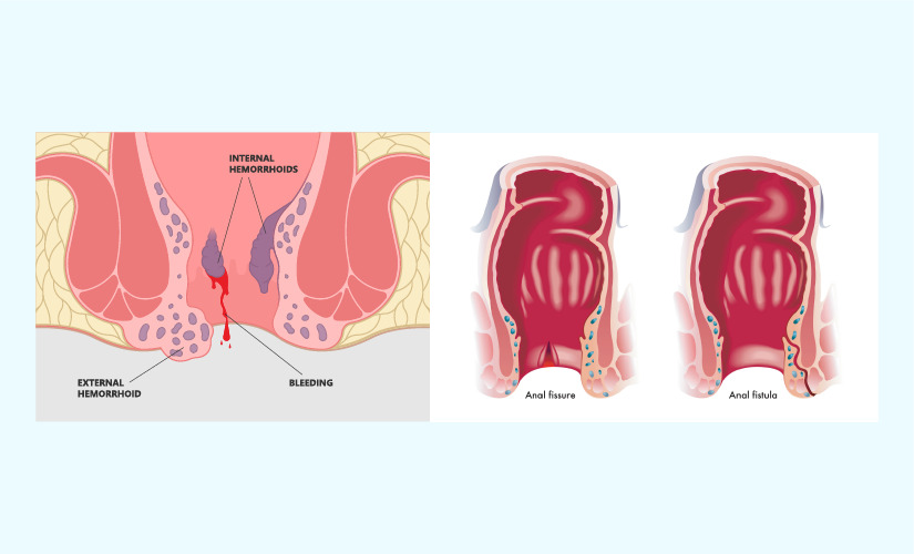 Fissure & Fistula