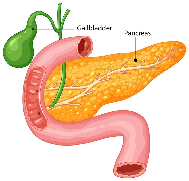 Gallstones