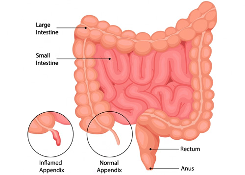 Appendix Surgeon